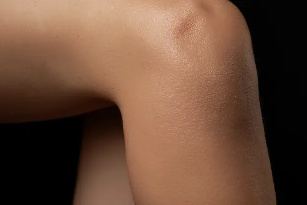 Image médicale illustrant les symptômes de l'eczéma sur la peau